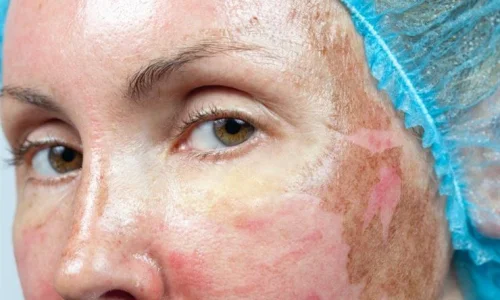 تجربتي مع التقشير الكيميائي للوجه