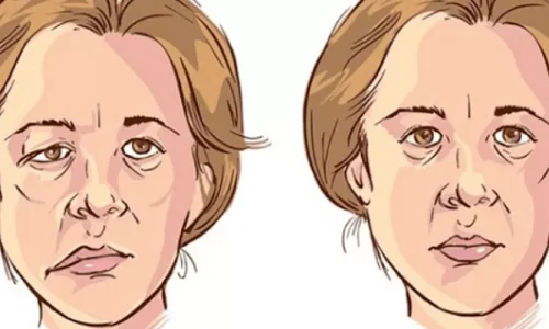 ما هي اعراض التهاب عصب الوجه؟