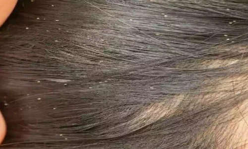 تأويلات ابن سيرين لتفسير رؤية القمل الميت في المنام للمتزوجة