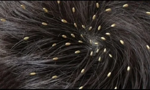 تعرف على تفسير رؤية القمل الميت في المنام لابن سيرين