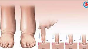 أسباب احتباس السوائل في الجسم وافضل طرق طبيعية للتخلص من احتباس الماء بالجسم