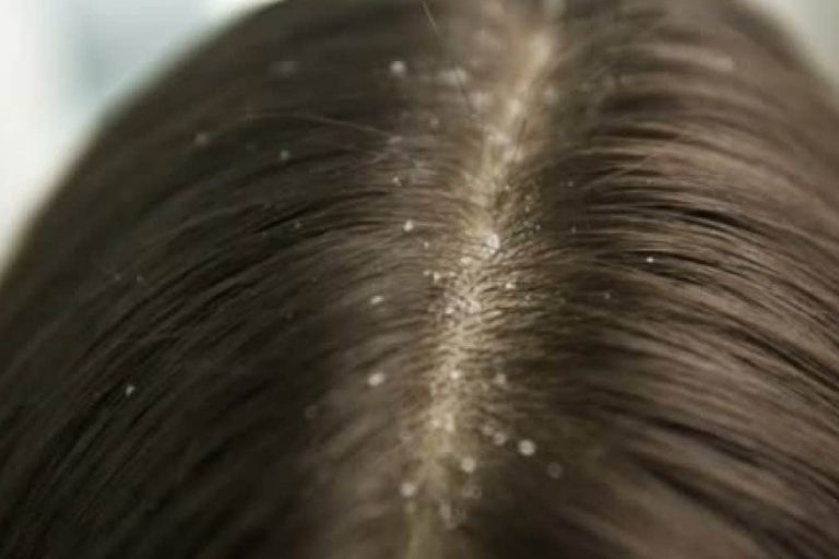 تفسير رؤية القمل في المنام لابن سيرين