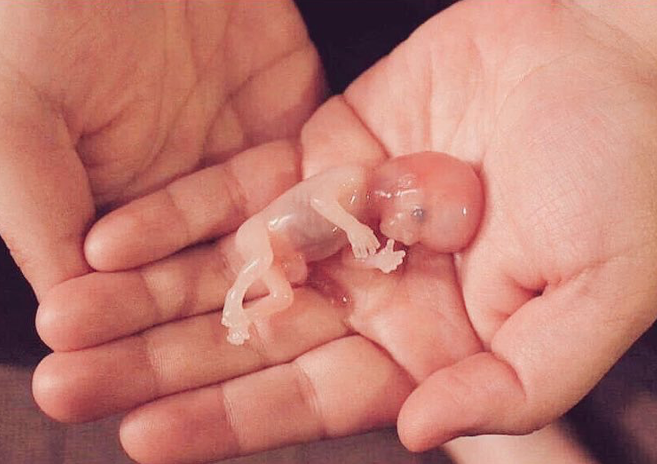 أسباب الإجهاض في الشهر الثاني