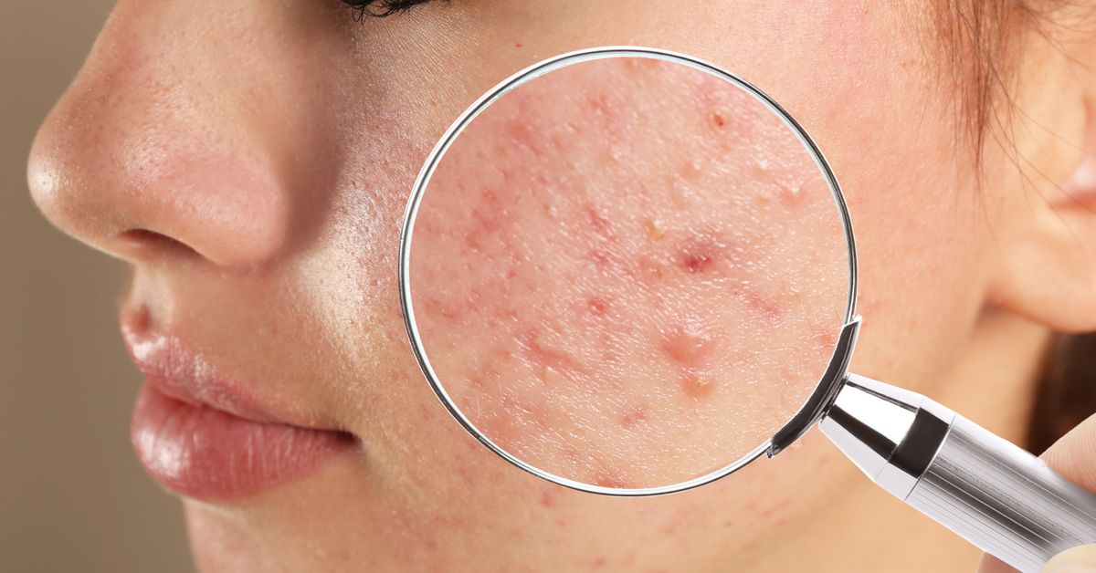 إزالة الحبوب من الوجه نهائياً