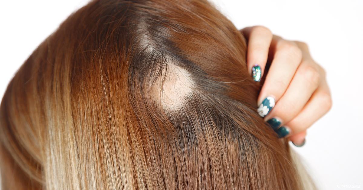 أعراض الثعلبة للنساء وما هي مدة علاج الثعلبة؟