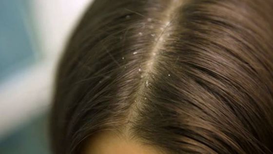 ما هو تفسير حلم قمل في الشعر في المنام لابن سيرين وكبار العلماء؟