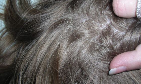 تفسير حلم القمل في الشعر للمتزوجة والحامل وتفسير حلم نزع القمل من الشعر للحامل