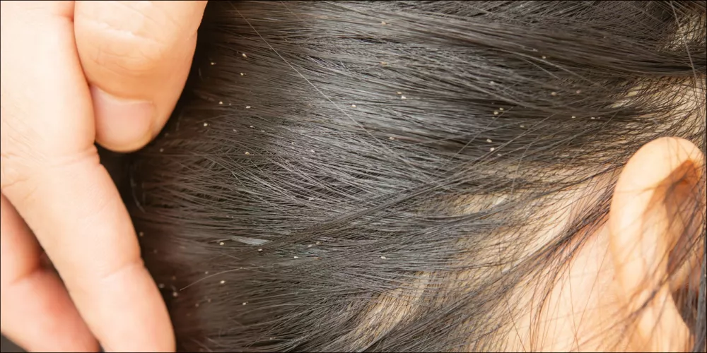 تعرف على تفسير رؤية القمل في المنام للعزباء لابن سيرين