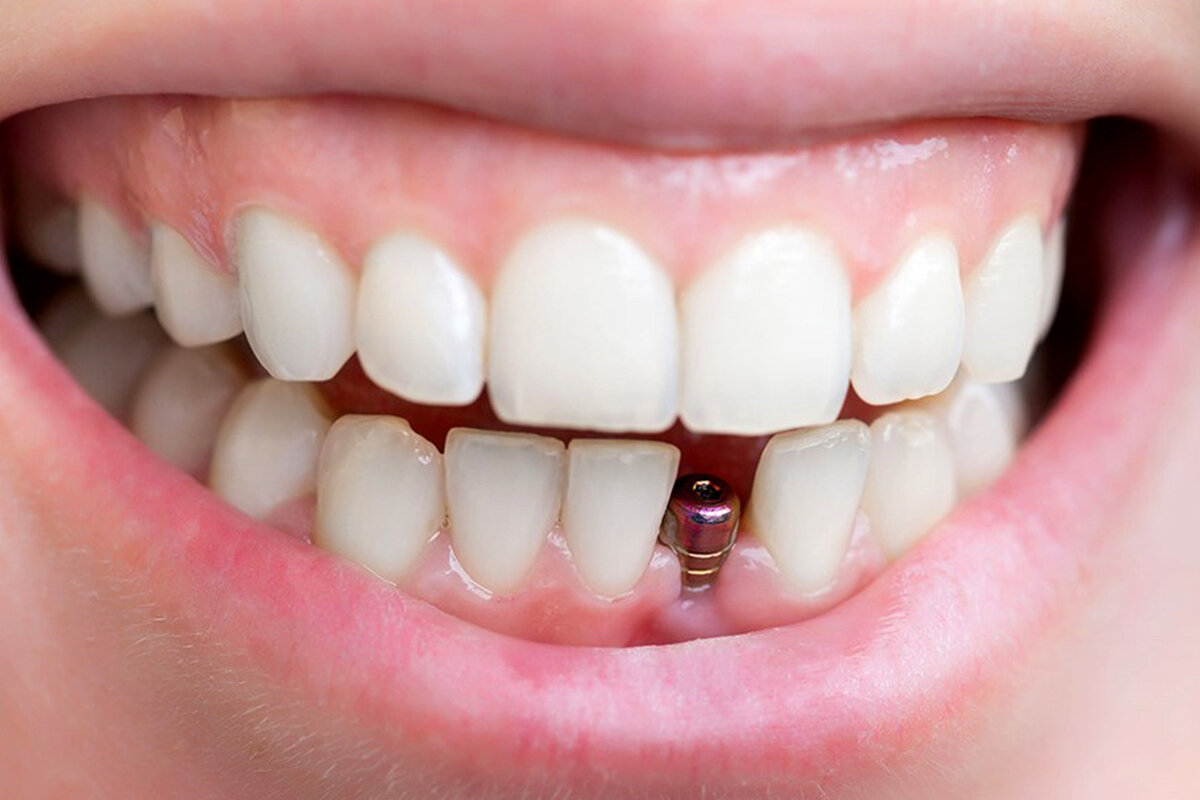 تفسير حلم السن مقسوم نصفين وما هو تفسير رؤية السن المنخور للعزباء؟